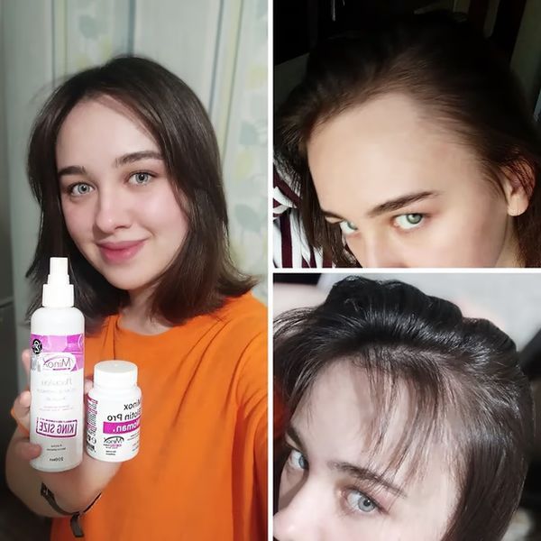 copy_Лосьйон для росту волосся (Мінокс) MinoX 2 Lotion-Spray для жінок Minoxidil 2% 50 мл copy_MN2 фото